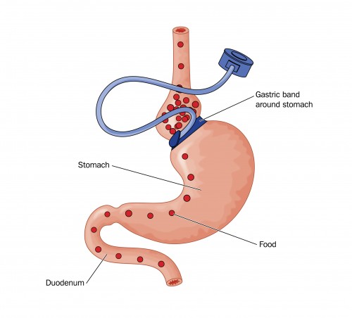 Bariatric Weight Loss Surgery Complications