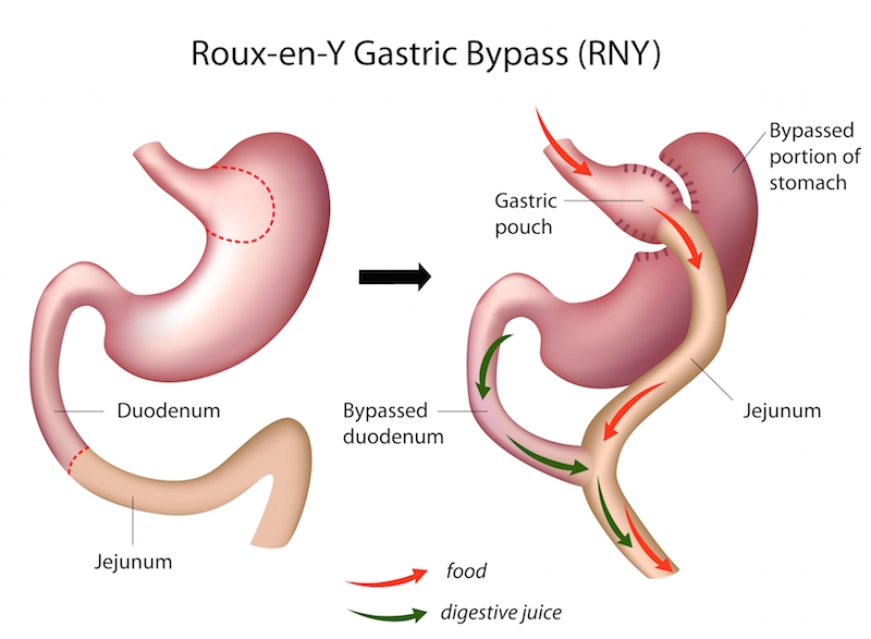 Roux En Y Gastric Bypass Rygb Facts Risks And Costs